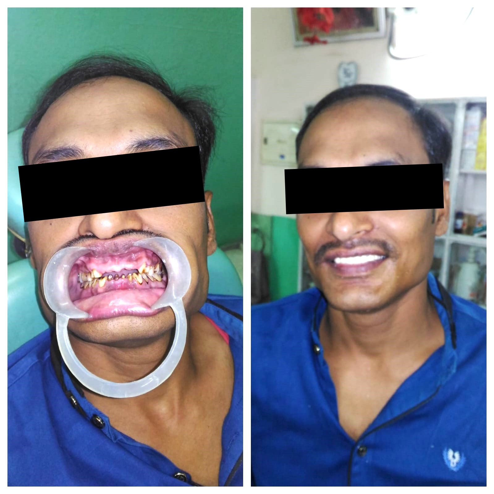 Patient smile transformation - Before and after dental treatment