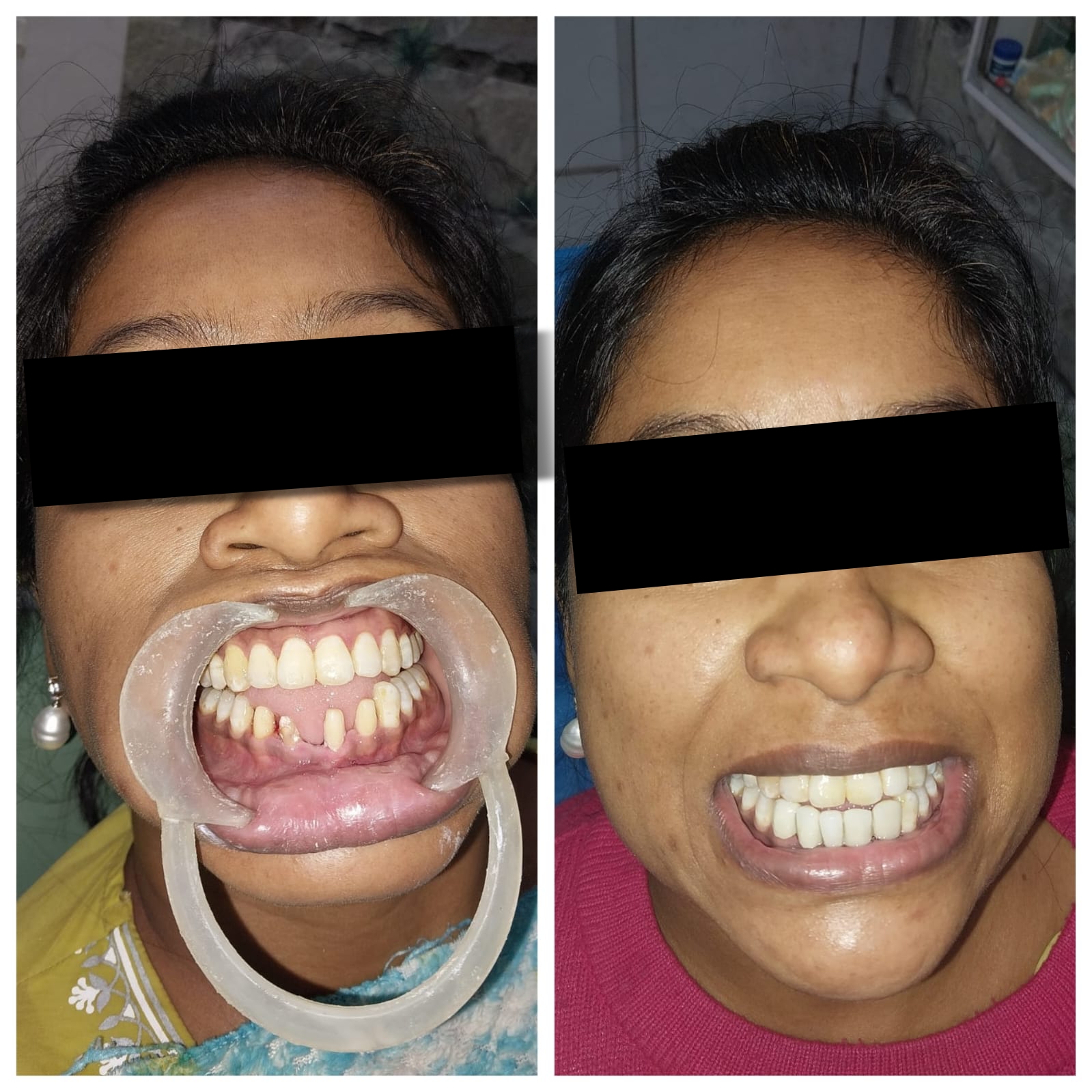 Dental restoration before and after - Patient result