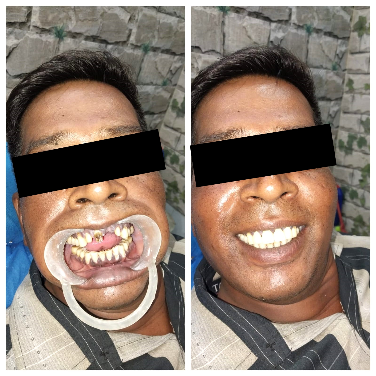 Teeth whitening and alignment before after