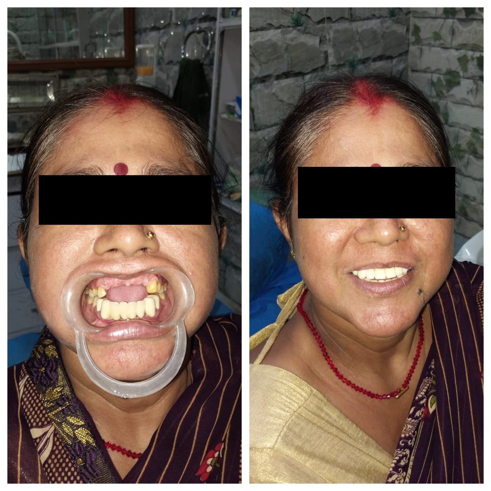 Complete smile makeover - Before and after dental work