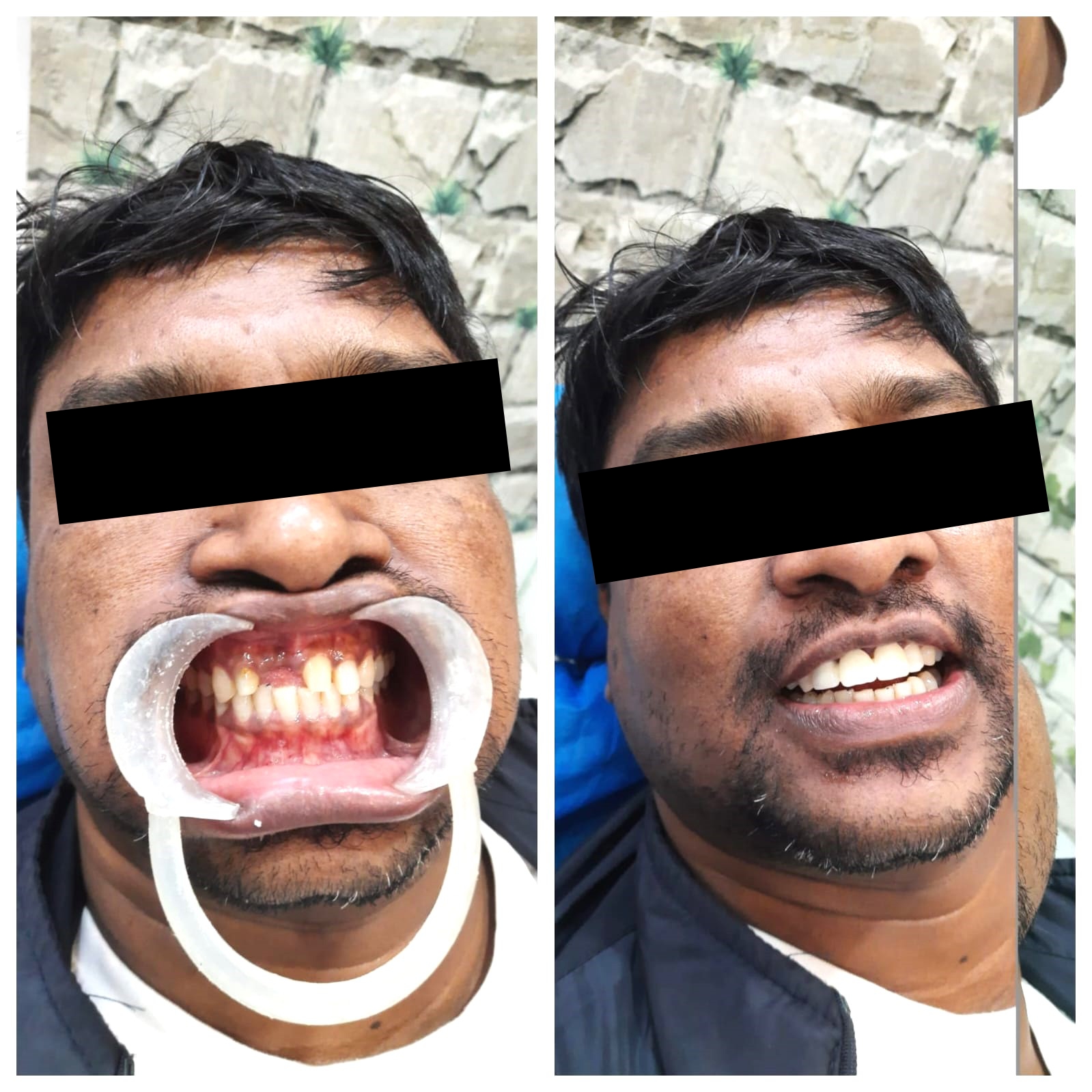 Dental transformation - Patient before and after results