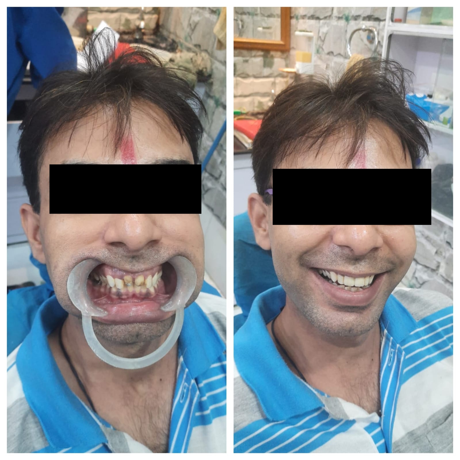 Smile restoration - Complete dental makeover results